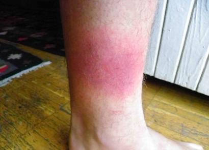 Красные пятна на ногах: причины и лечение На ноге появилось красное пятно чем лечить